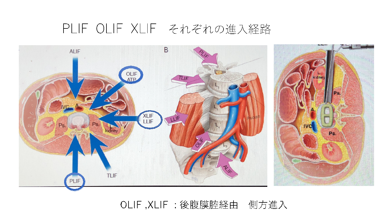 PLIF OLIF XLIF それぞれの進入経路